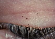 Infestación de piojos