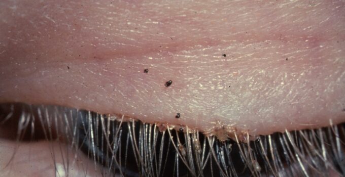 Infestación de piojos