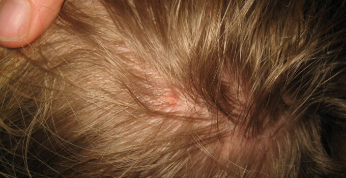 Infestación de piojos